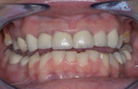 Intraoral clinical image
