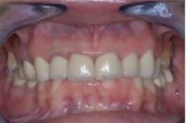 Radiograph showing bone loss