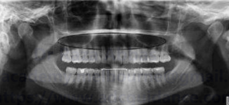 White spot lesion