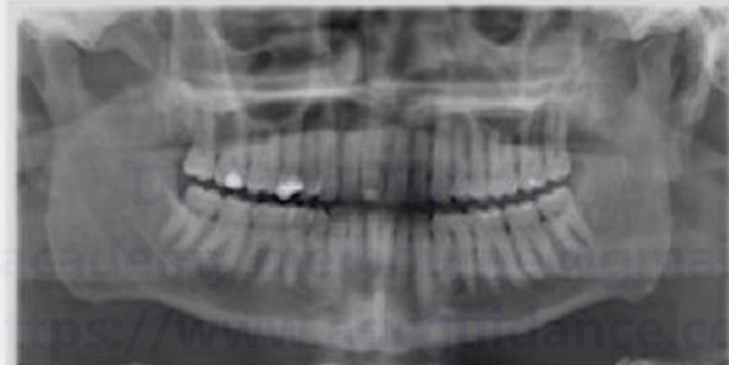 White spot lesion
