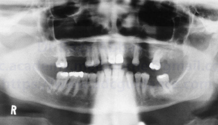 White spot lesion