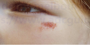 White spot lesion