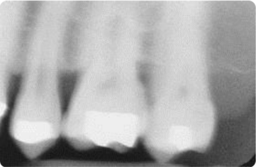 White spot lesion