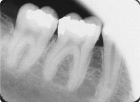White spot lesion