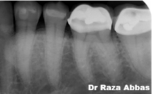 White spot lesion