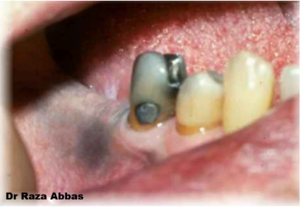White spot lesion