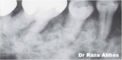 White spot lesion