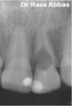 White spot lesion